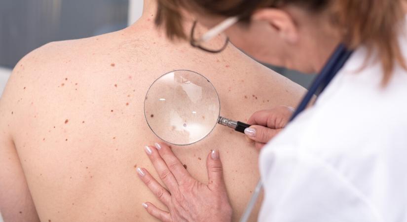 Már embereken tesztelik a bőrrák elleni vakcinát