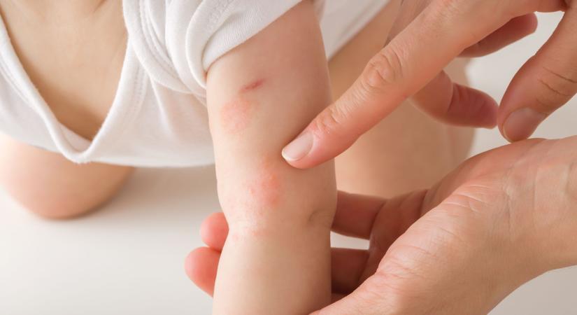 Mi okozhat kiütéseket a csecsemő bőrén? Ezek állhatnak a háttérben