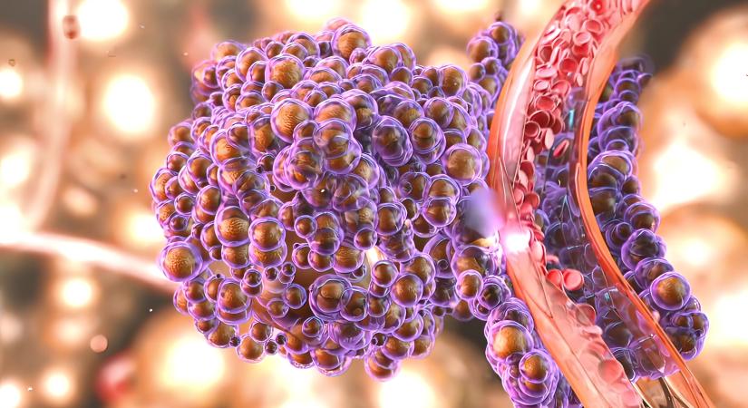 Kiújuló rák: miért és hol újulhat ki a tumor? Onkológus mondja el