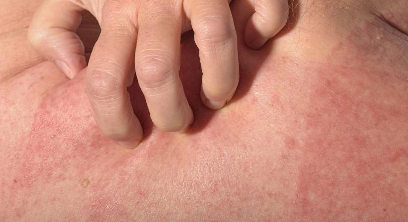 Melegkiütés vagy napallergia okozza a tüneteket? A bőrgyógyász elmondja