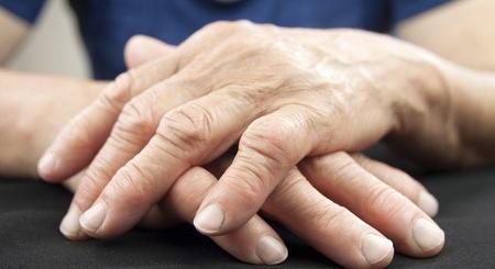 A szervezet antitest-szűrő funkciójának meghibásodása okozhatja a rheumatoid arthritist