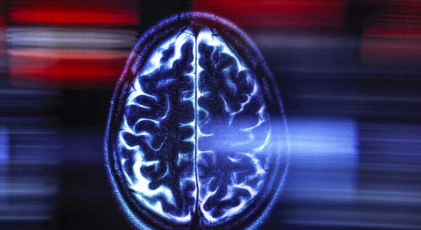 Alzheimer-kór: újabb áttöréshez értek a kutatók