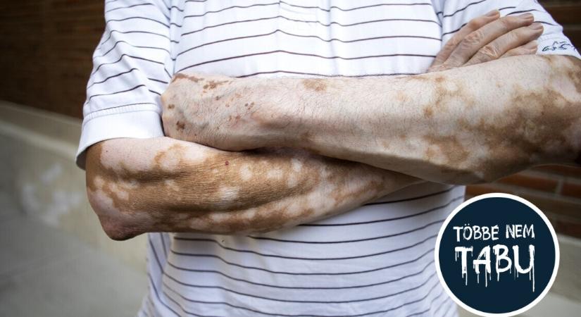 „Miért vagy olyan pöttyös, mint egy boci?” – a gyerekek a legőszintébbek a vitiligo kapcsán