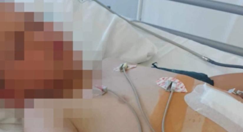 Négy lányosztálytársa bántalmazott egy tízéves fiút Kemecsén, el kellett távolítani a lépét