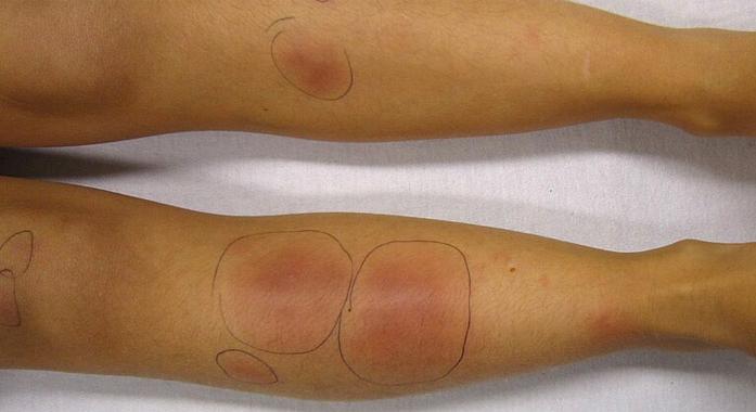 Csomók a bőr mélyén: erythema nodosum