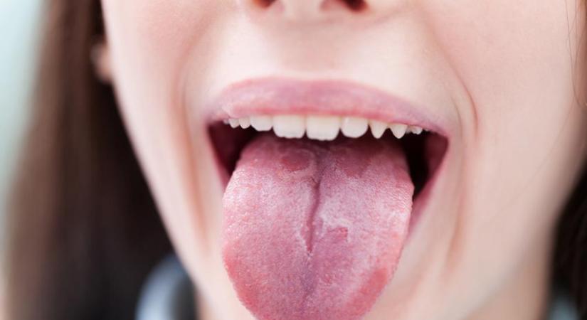 Szőrös, csipkés, lepedékes - ezt árulja el a nyelve az egészségéről