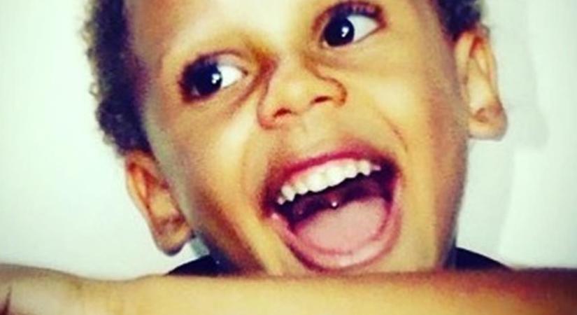 Betört a divat világába egy ritka betegséggel született brazil kisfiú