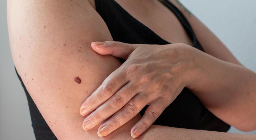 Bőrrák-megelőző állapot: a bőrgyógyász elárulja, honnan ismerheti fel