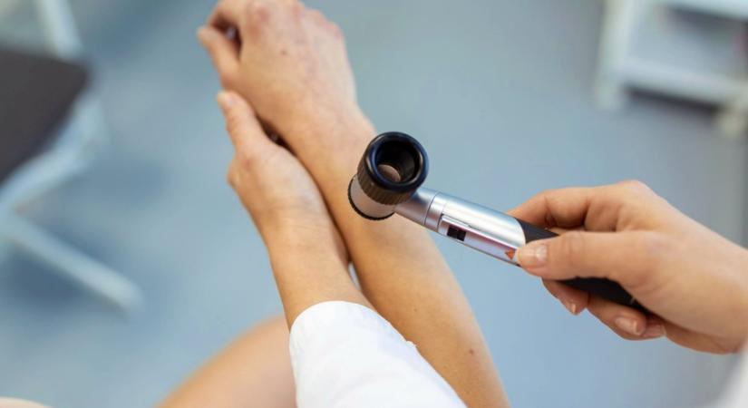 A rendszeres önellenőrzés és a bőrgyógyászati szűrővizsgálat megelőzheti a melanómát