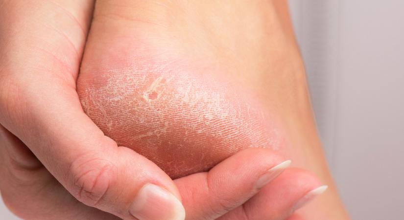 Eltűnik a makacs bőrkeményedés, puha lesz a láb: praktikák, melyek tényleg beválnak