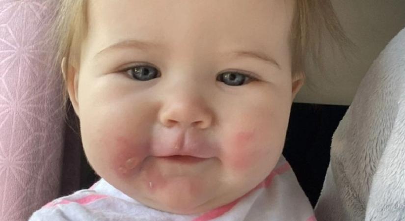 Zellert evett a 7 hónapos lány, majdnem az életébe került: „Úgy nézett ki, mintha égési sérülései lennének”