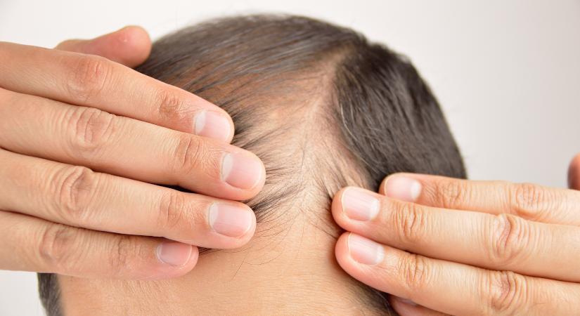 Mit tehet egy férfi hajhullás ellen, ha örökölte a hajlamot? Orvos mondja el
