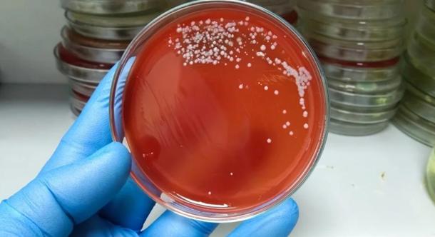 Gyorsan terjed Japánban a húsevő baktérium által okozott megbetegedés