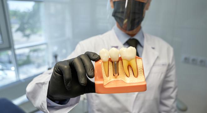 A füstmentes dohánytermékek károsítják leginkább a fogimplantátumot