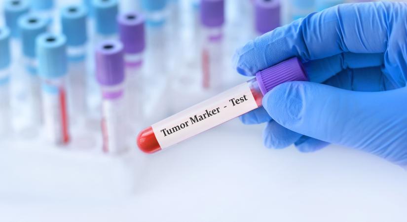 Nőgyógyászati daganatok - ekkor érdemes ellenőriztetni a tumormarkereket