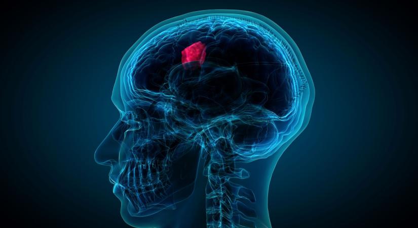 Új kutatás: ezek a tényezők befolyásolhatják az agydaganatok kialakulását