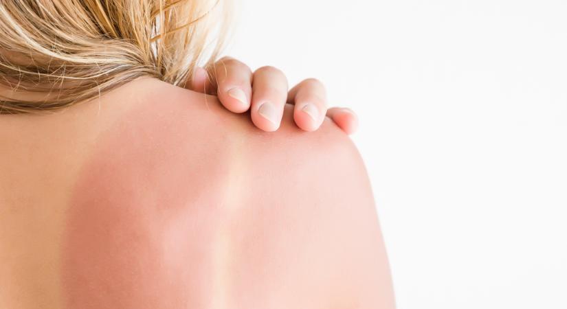 Hatékony módszerek napégés ellen - ezért vigyázzon nagyon a bőrére