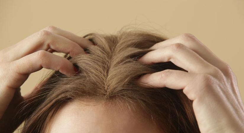 Íme 16 tuti tipp, hogy hogyan kezeld a száraz fejbőr okozta kellemetlenségeket