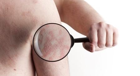 Atópiás dermatitisz: gyanú esetén forduljon szakemberhez