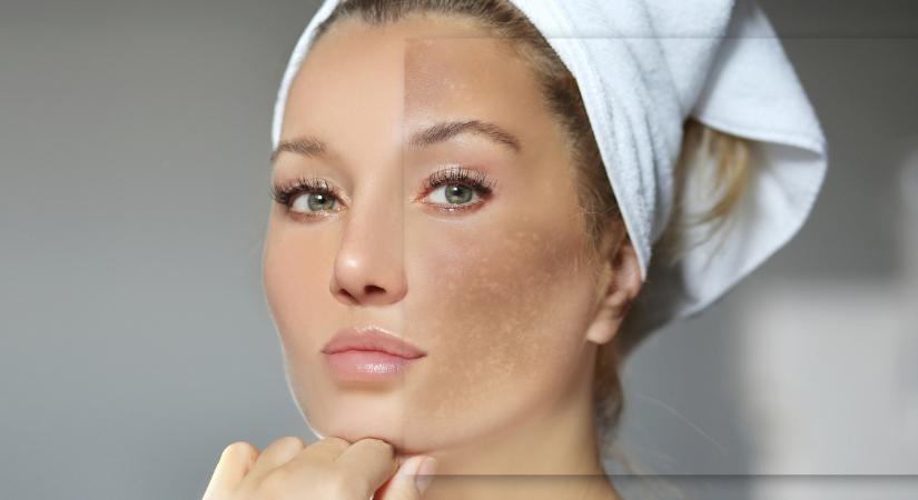 Mi okozza a hiperpigmentációt a bőrön, és mit tehetsz ellene? – nemcsak az UV-sugárzás a ludas