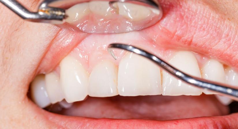 Kezelés közben törte el egy nő állkapcsát a fogorvos