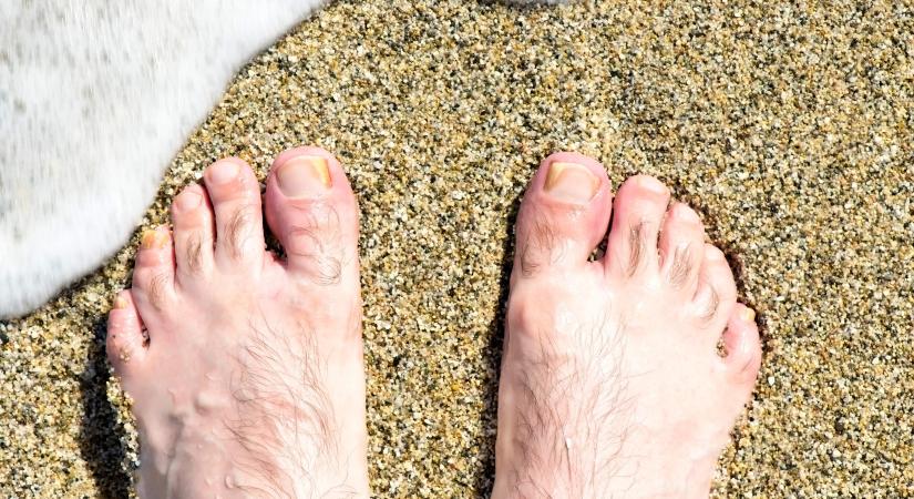 Gombás fertőzés a strandon: ebből jöhet rá, ha lábgombája van