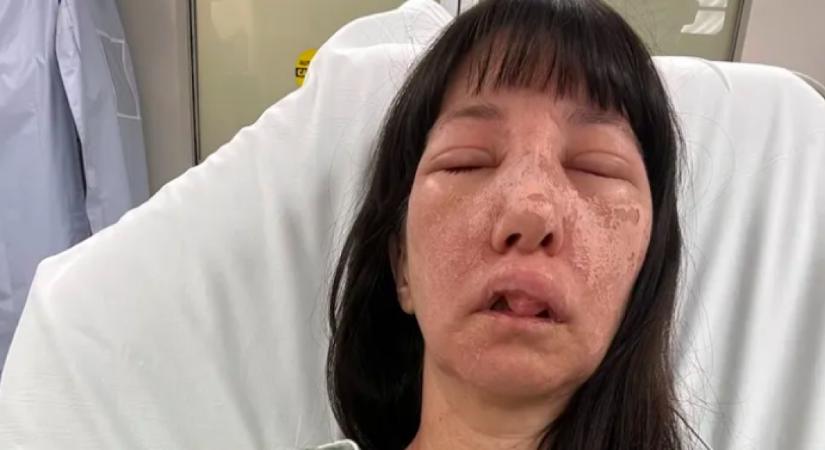 Szemkárosodás, kiütések, fájdalom: kórházba került a nő, akit megmart egy pók - Fotók
