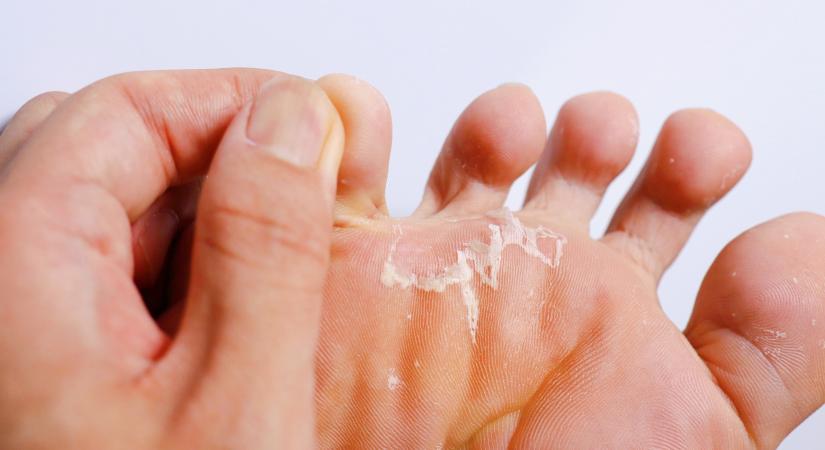 A fehéresen felázott bőr is utalhat lábgombára - ilyen gombákkal fertőződhet meg a bőr