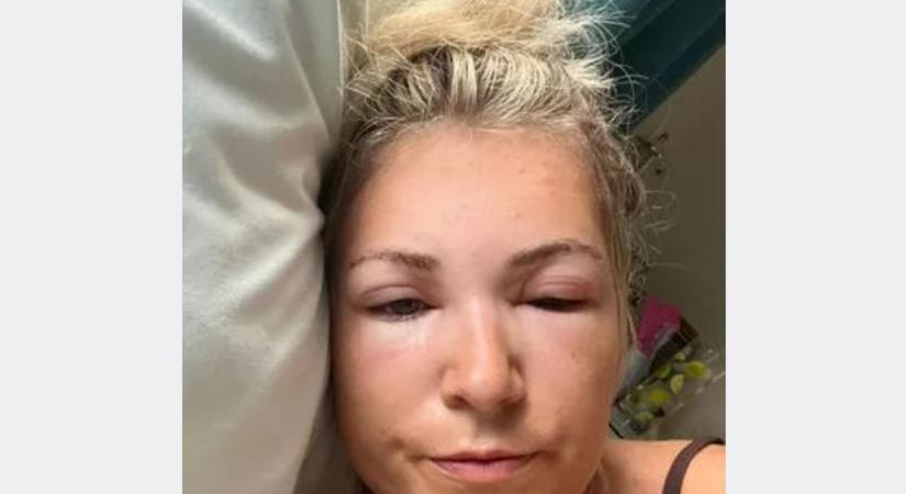 "Az egész arcom bedagadt" - napmérgezést kapott Tamara Budapesten, azonnal kórházba vitték