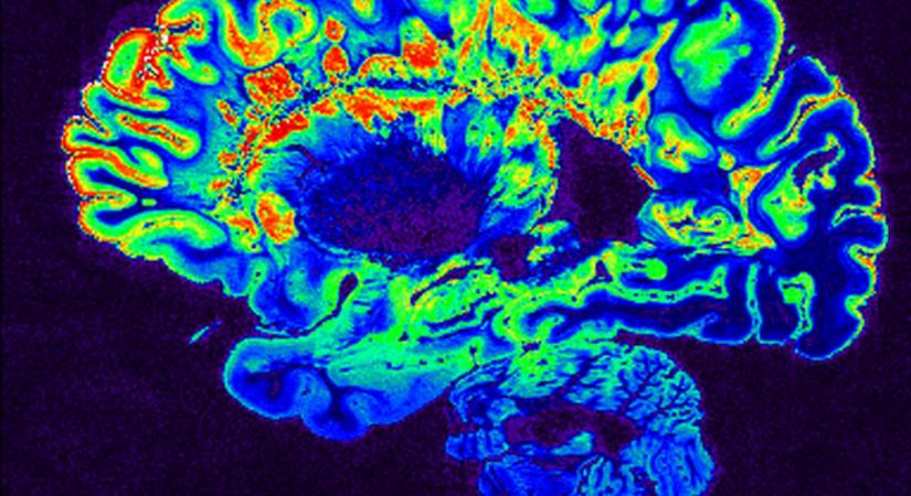 A mesterséges intelligencia képes azonosítani a gyerekek nemét MRI-felvételek alapján