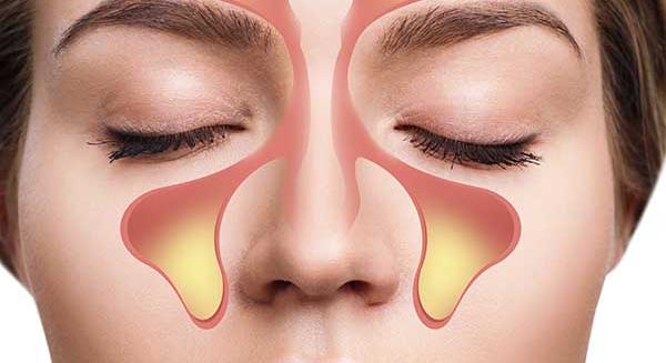 Kiújuló arcüreggyulladás: orrpolip és reflux is okozhatja?
