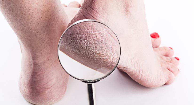 Bőrkeményedés, repedezett sarok: a pajzsmirigyzavar a lábunkon is nyomot hagy