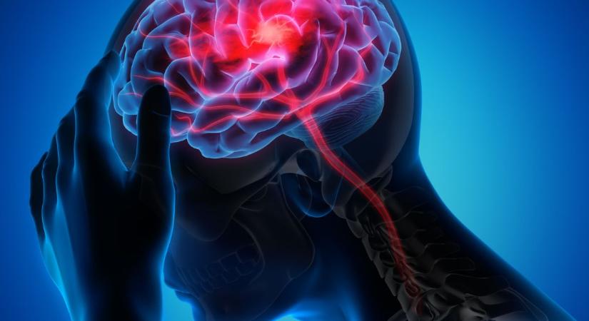 Előzd meg a stroke-ot! – Ez a 10 dolog növeli az agyi érkatasztrófa esélyét