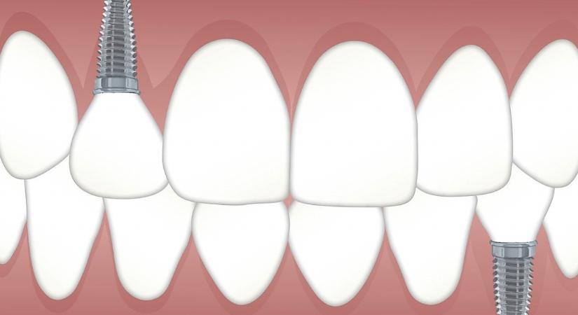 Hasznos tudnivalók a fogimplantátumok kapcsán