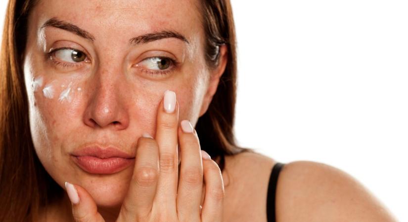 Melazma: mit tehetünk nyáron az arc barna foltosodása ellen?