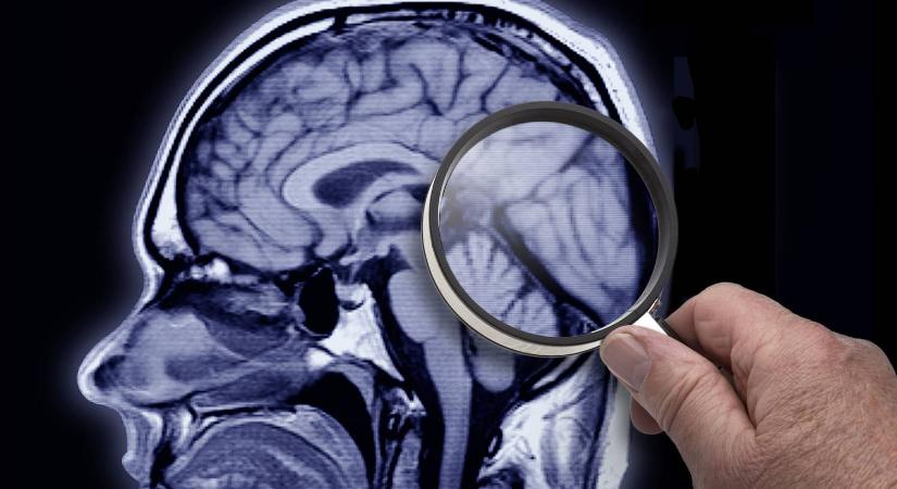 Egy új vizsgálat még a tünetek megjelenése előtt kimutatja az Alzheimer-kórt