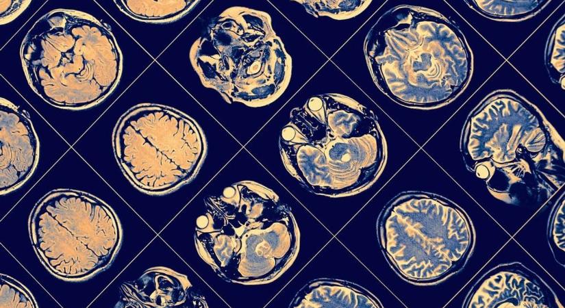 A mesterséges intelligencia közel 80 százalékos pontossággal felismeri az Alzheimer-kórt – de hogyan?