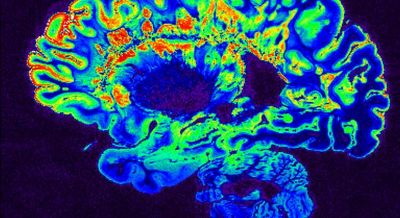 Van egy agyi hálózat, amely lényegesen kiterjedtebb a depresszióval élő személyeknél