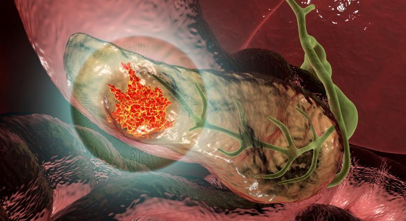 Hasnyálmirigyrák: ez a székletvizsgálat, már korai stádiumban kimutathatja