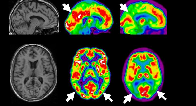 Az Alzheimer-kórra használt terápia jó lehet a második leggyakoribb demencia típusra is