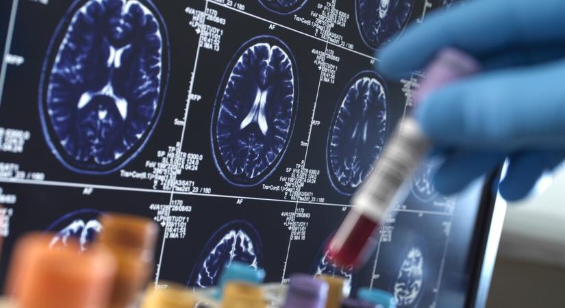 Alzheimer-kór: óriási lépést tettek kutatók a megelőzés felé