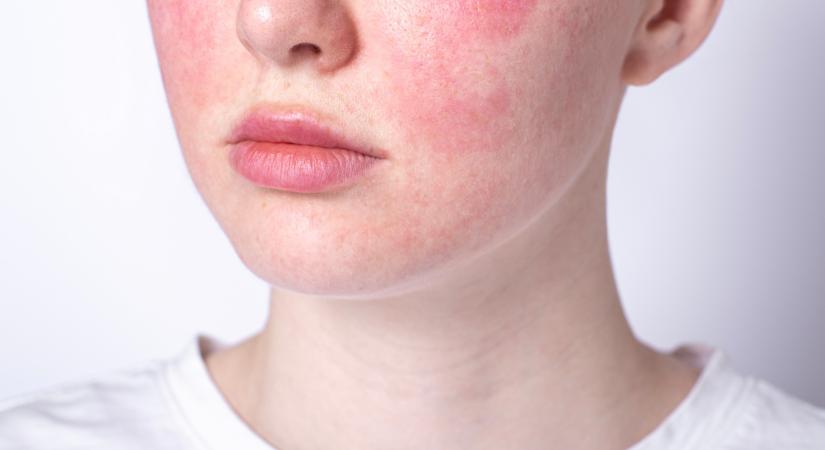 Piros erek az orron, érzékeny, vöröslő arc: így enyhítheti a rosacea tüneteit