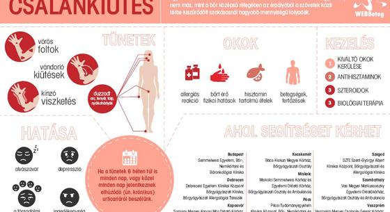 A csalánkiütésről (infografika)