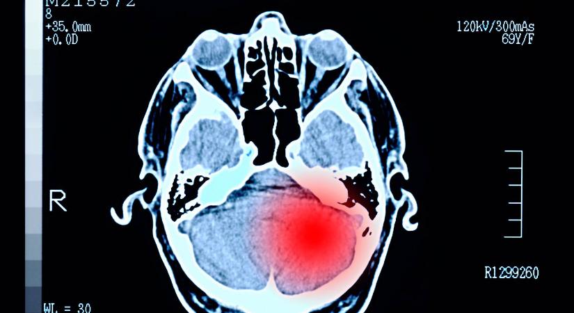 Új áttörés az agydaganatok kezelésében: heteken belül zsugorítja a daganatokat