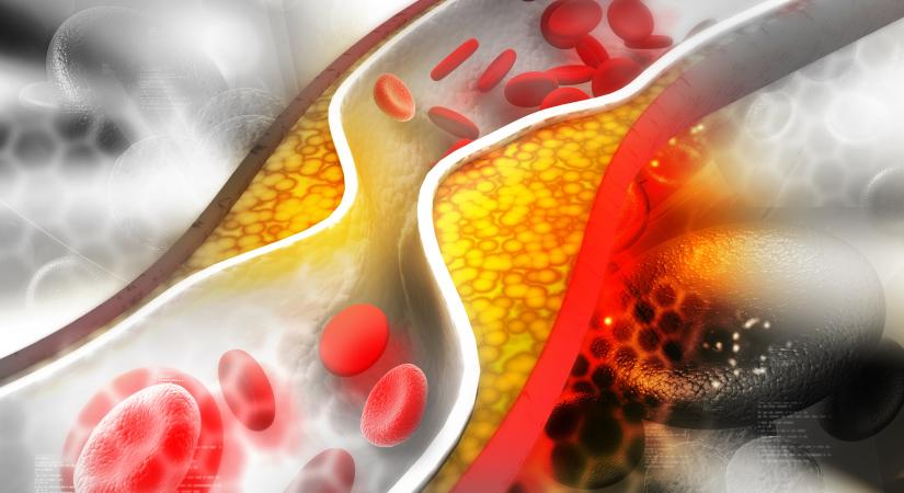 Mitől magas a koleszterin? Ezek lennének a normális vérzsírszint értékek