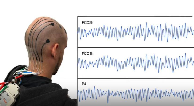 Az ideiglenes fejbőrtetoválás nyomon követheti az agyhullámaidat