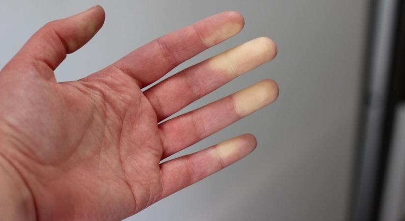 Elfehéredik az ujjad? Neked is Raynaud-szindrómád lehet