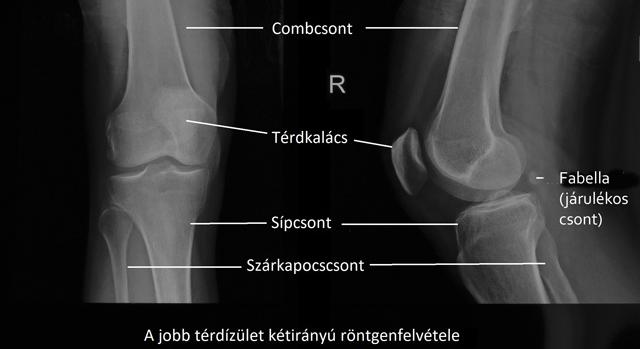 Térdről készült röntgenfelvétel