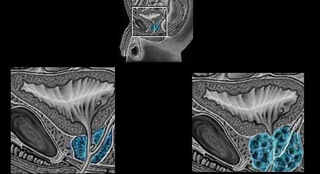 Évente 1100-1400 férfi hal meg prosztatarákban – Ön ne legyen közöttük