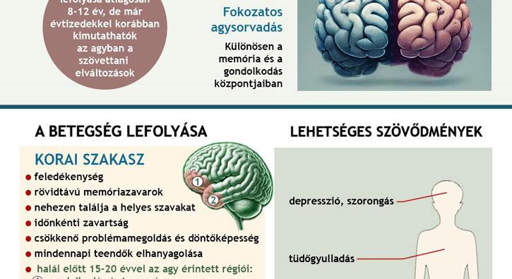 Alzheimer-kór infografika